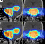 脑膜瘤是怎么长出来的?脑膜瘤会遗传吗?