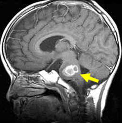 脑干胶质瘤