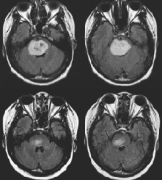 脑干胶质瘤核磁案例解读