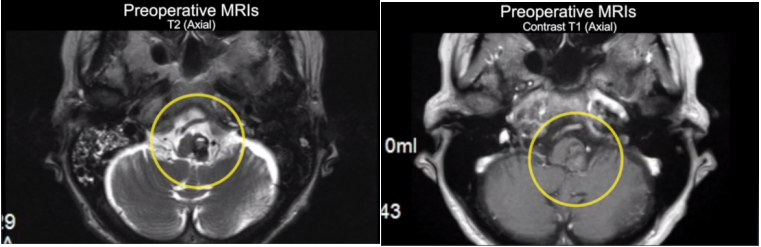 <a href='/bingzhong/xueguanliu/' target='_blank'><u>脑海绵状血管瘤</u></a>术前MRI