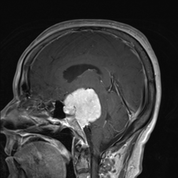 岩斜区脑膜瘤