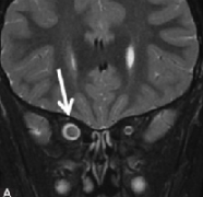 视神经胶质瘤MRI影像解读