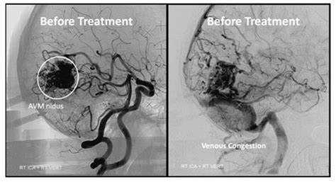 问:脑动静脉畸形栓塞有用吗?
