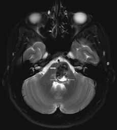桥脑海绵状血管瘤出血导致米勒德-古布勒综合征