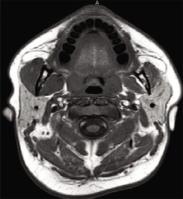 三叉神经鞘瘤表现为错颌畸形：1例报告并文献复习