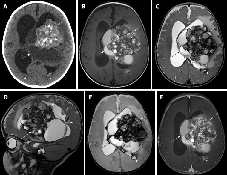 <a href='/bingzhong/xueguanliu/' target='_blank'><u>脑海绵状血管瘤</u></a>