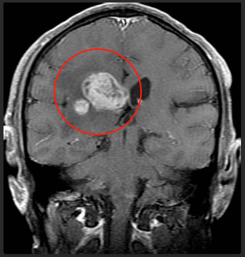 儿童丘脑胶质瘤好治吗？