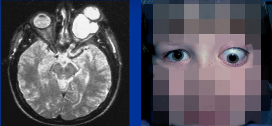 儿童视神经胶质瘤