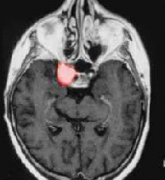 在大脑危险区域手术：有效、安全地治疗海绵窦脑膜瘤