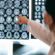 低级别脑部胶质瘤如何治疗？儿童良性脑胶质瘤全切案例