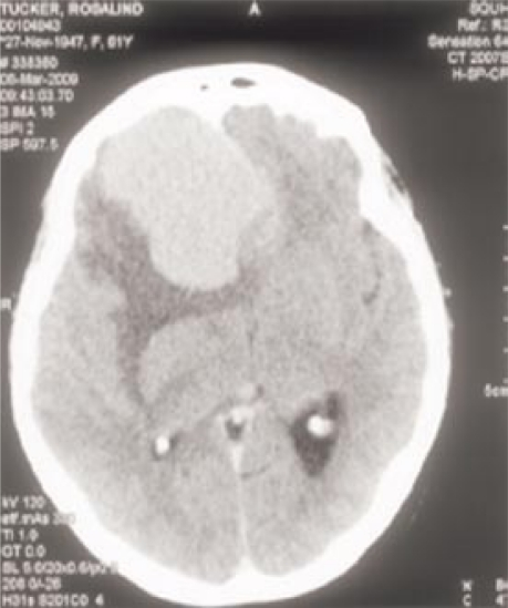 脑膜瘤患者自述：脑肿瘤会给你的生活带来什么？