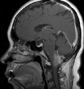 脑胶质瘤概述之：脑干延髓胶质瘤预后如何？