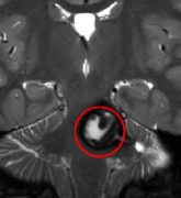 脑海绵状血管瘤手术案例分析：4岁患儿脑干肿瘤，能手术吗