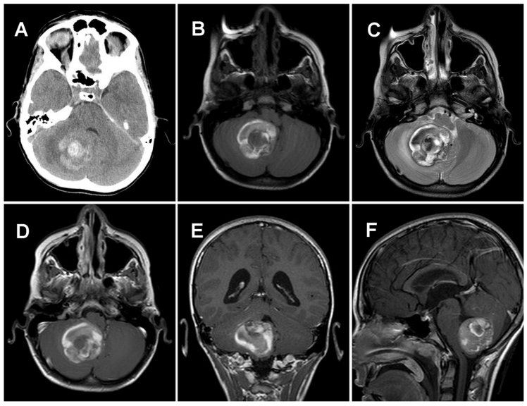 儿童小脑毛细胞星形细胞瘤表现为自发性瘤内出血