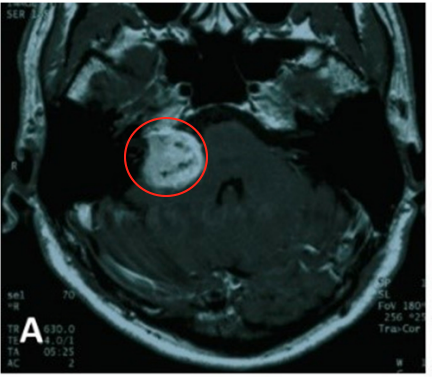听神经瘤怎样有效治疗？反复手术、放疗10年后听神经瘤恶变病例详析