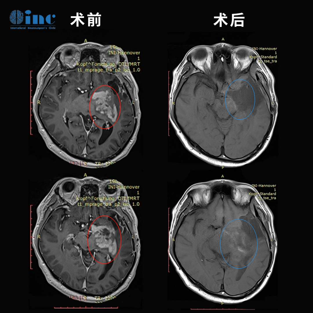 功能区胶质瘤手术案例(质子治疗)