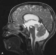 脑干胶质瘤有哪些类型？