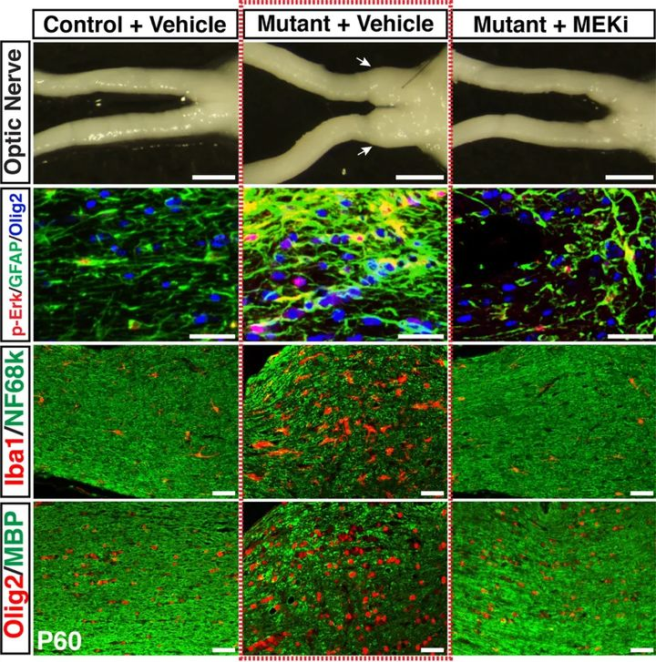 Developmental Cell：研究人员发现关键发育时期治疗可预防NF1相关视通路胶质瘤的发生