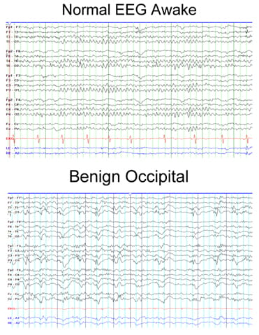 良性枕叶癫痫的症状、诊断和治疗
