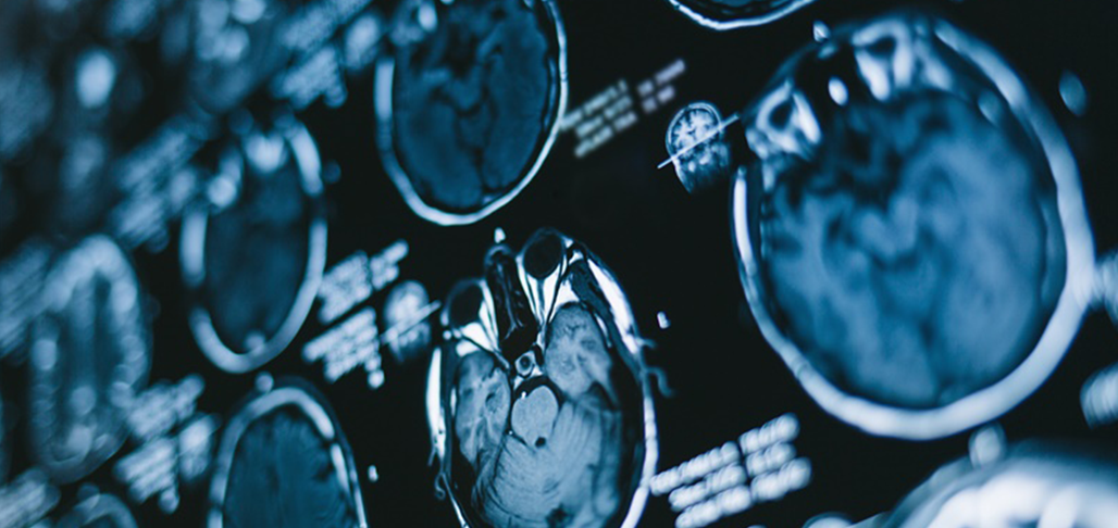 瑞博西尼联合依维莫司治疗高级别胶质瘤