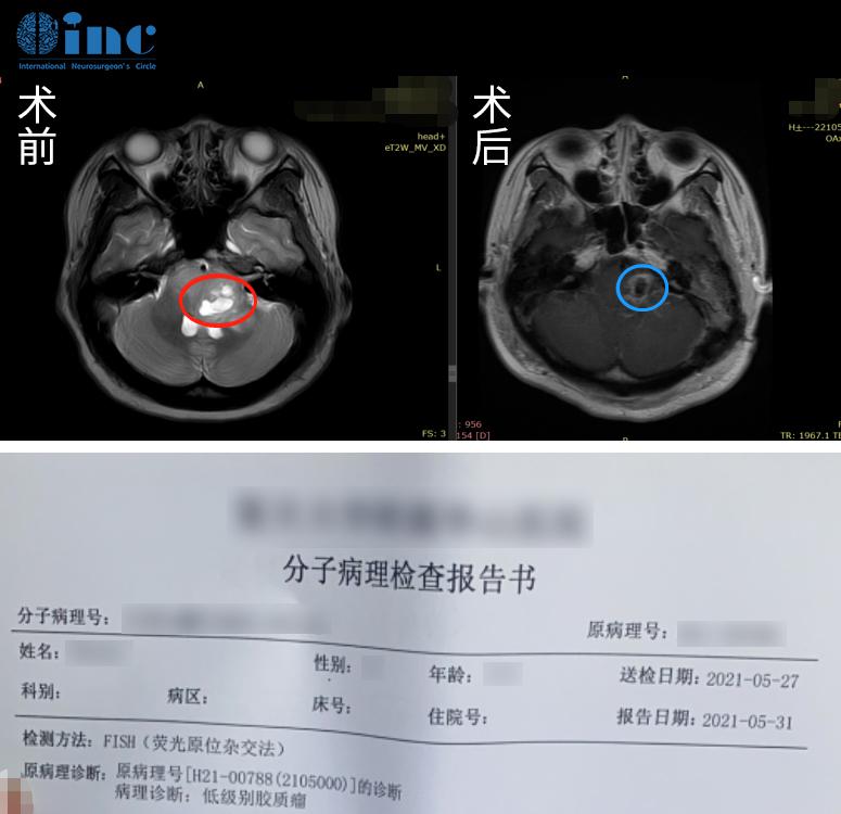 脑瘤手术怎样才算成功，如何争取最大的手术成功率？一文了解清楚