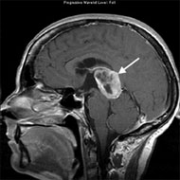 残余或复发性非功能性垂体瘤如何治疗？