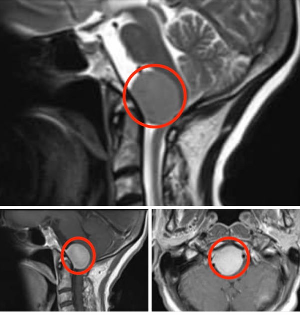 枕骨大孔区脑膜瘤怎么选择合适的手术入路？