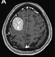 慢性头痛原来是多发脑膜瘤“作怪”，是观望还是手术?
