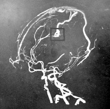 脑动静脉畸形因何破裂？有何危害？如何治疗？