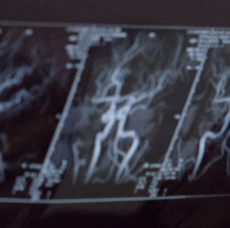 脑海绵状血管瘤出血风险高吗？严重吗