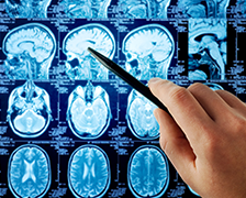 丘脑胶质瘤能治愈吗?