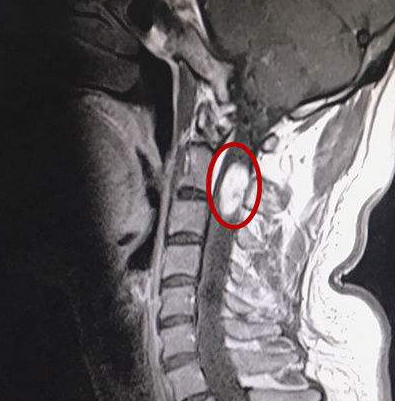 解密脊髓肿瘤：要尽早手术更要选对技术