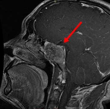 经过手术后的脊索瘤到底会不会复发?