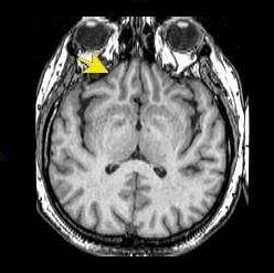 小儿松果体区肿瘤怎么治?国际多种前沿治疗方式可合适治疗