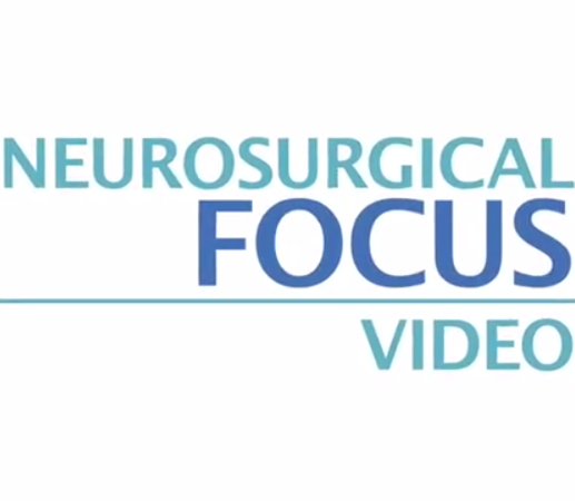 【视频交流】国际神经外科学院主席Couldwell教授对dAVF的动脉血管内栓塞治疗