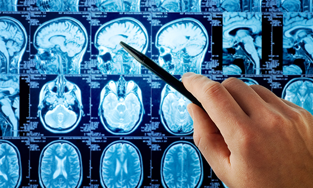 脑膜瘤3Cm严重吗?脑膜瘤手术后多久恢复？