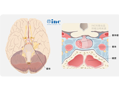  大于3cm的垂体瘤，怎么治疗才能更完全、不复发？