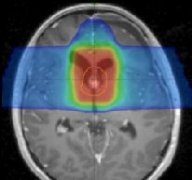 儿童常见脑瘤质子治疗效果实例解析