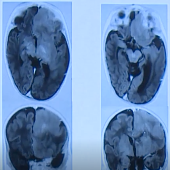 半侧巨脑综合征怎么治？国际儿童颅底学会创始人Di Rocco教授解读