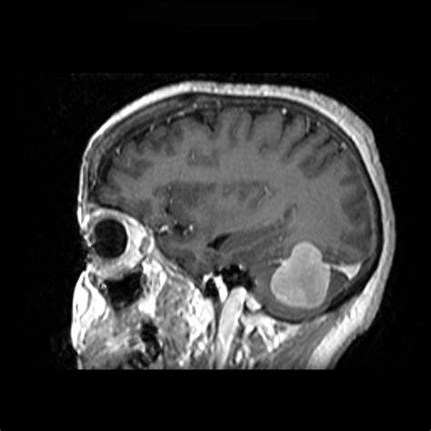 脑膜瘤治疗好方法