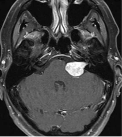 听力下降警惕脑瘤：数次不重视，听神经瘤在她脑中生长了十年