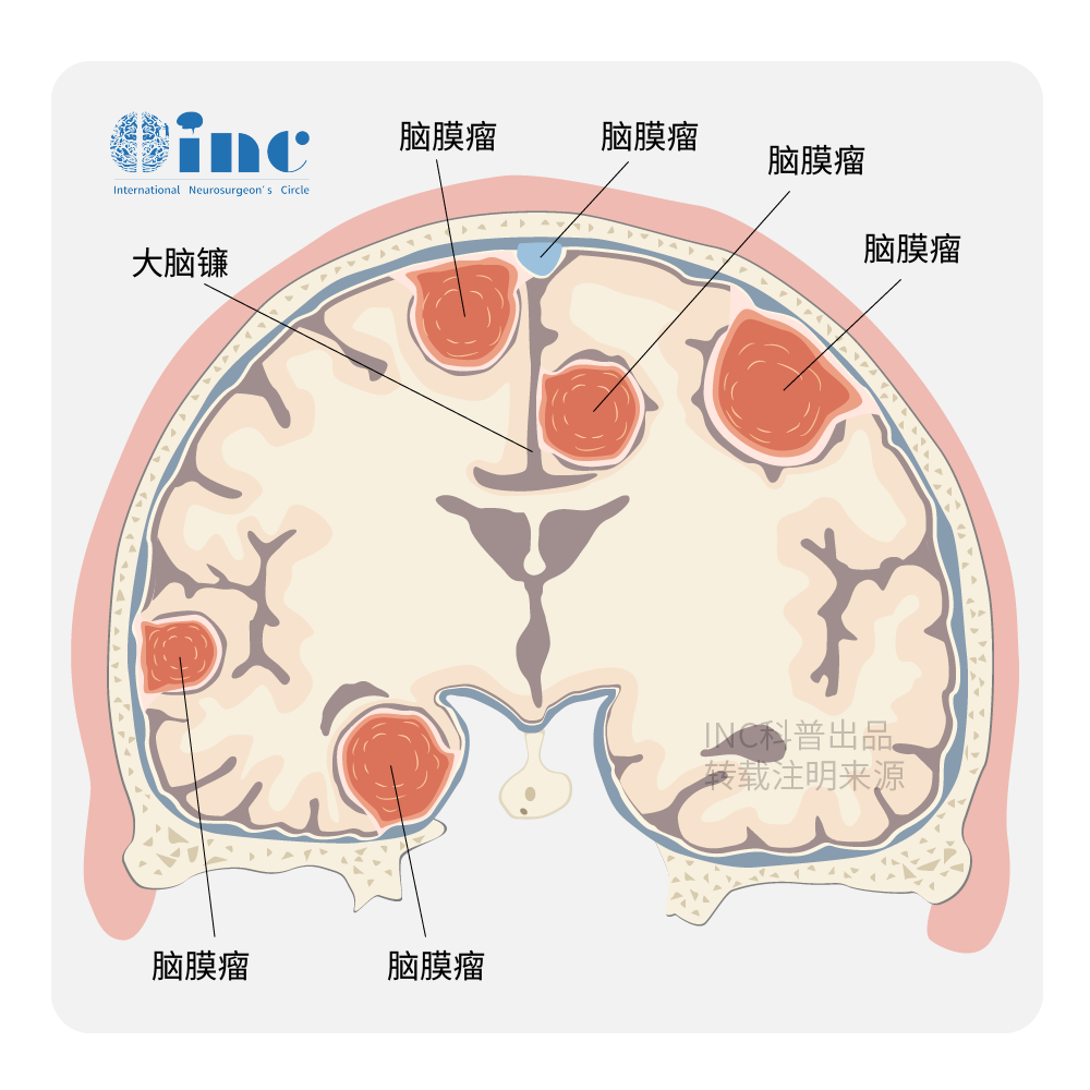 前床突脑膜瘤严重吗？手术治疗效果如何？