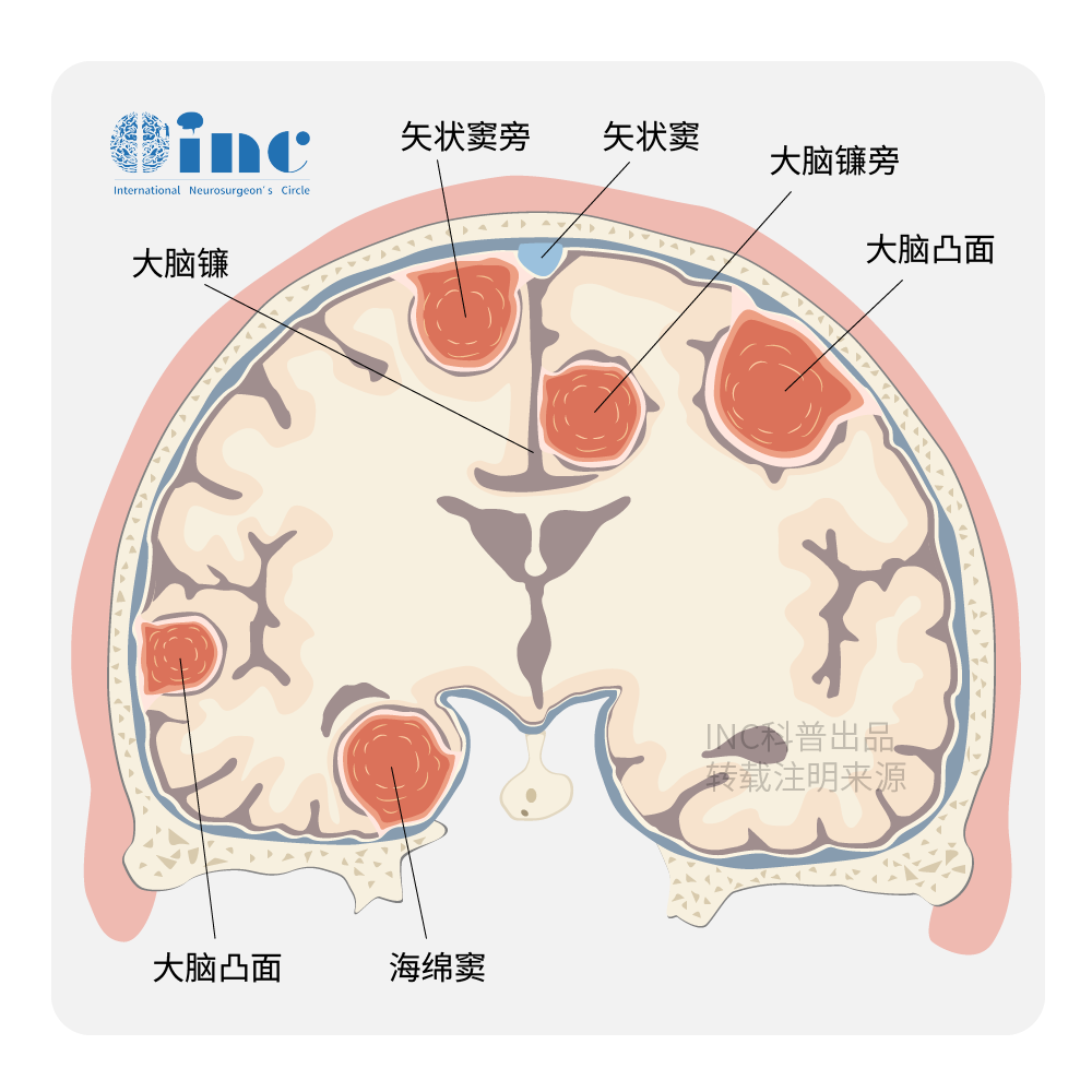 矢状窦旁脑膜瘤治疗