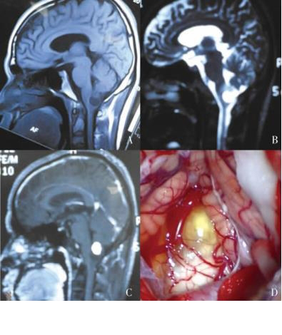 枕骨大孔区<a href='/bingzhong/naomoliu/' target='_blank'><u>脑膜瘤</u></a>手术成功率高吗