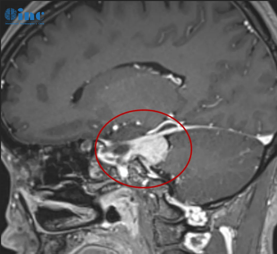 良性脑膜瘤能活多久-1