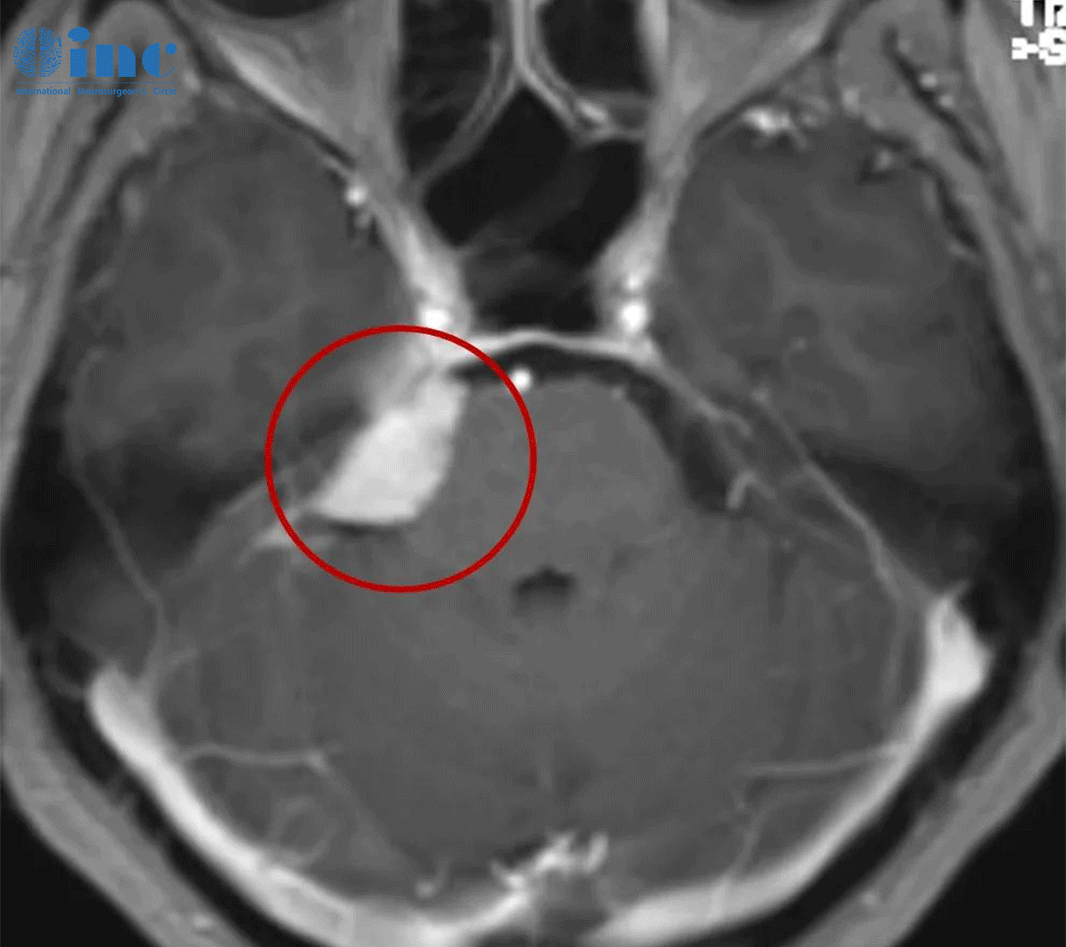 良性脑膜瘤能活多久-2