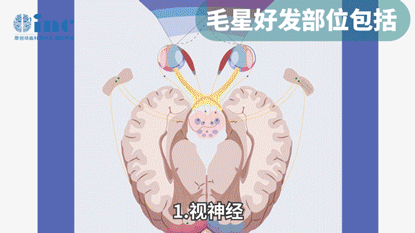 毛细胞型星形细胞瘤可以治愈吗