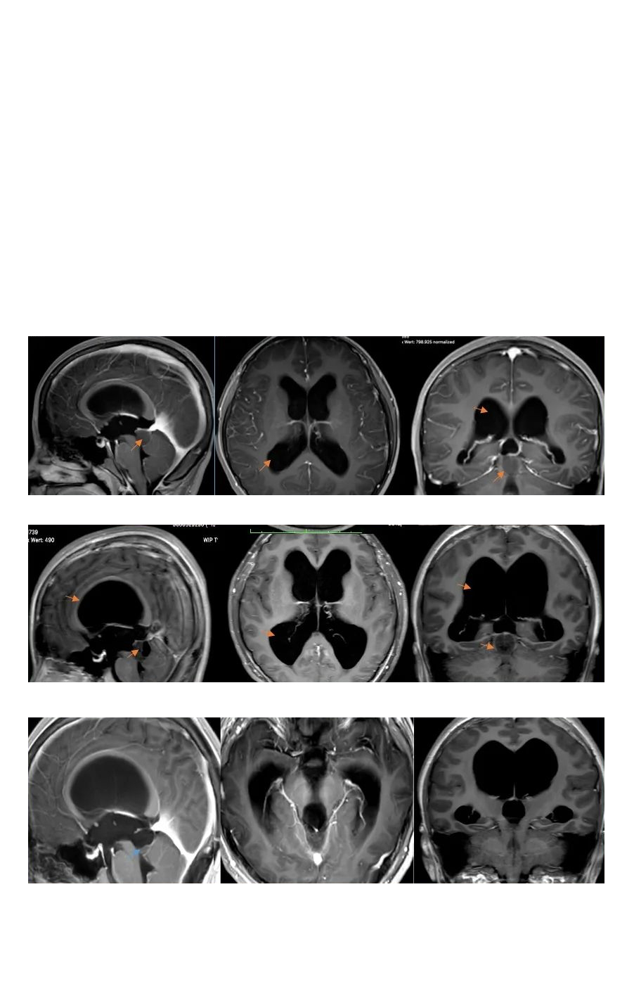 毛细胞型星形细胞瘤1级会复发吗