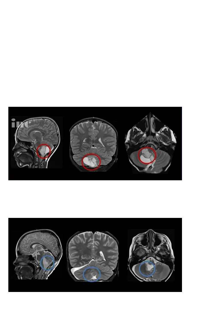 毛细胞型星形细胞瘤病理-5