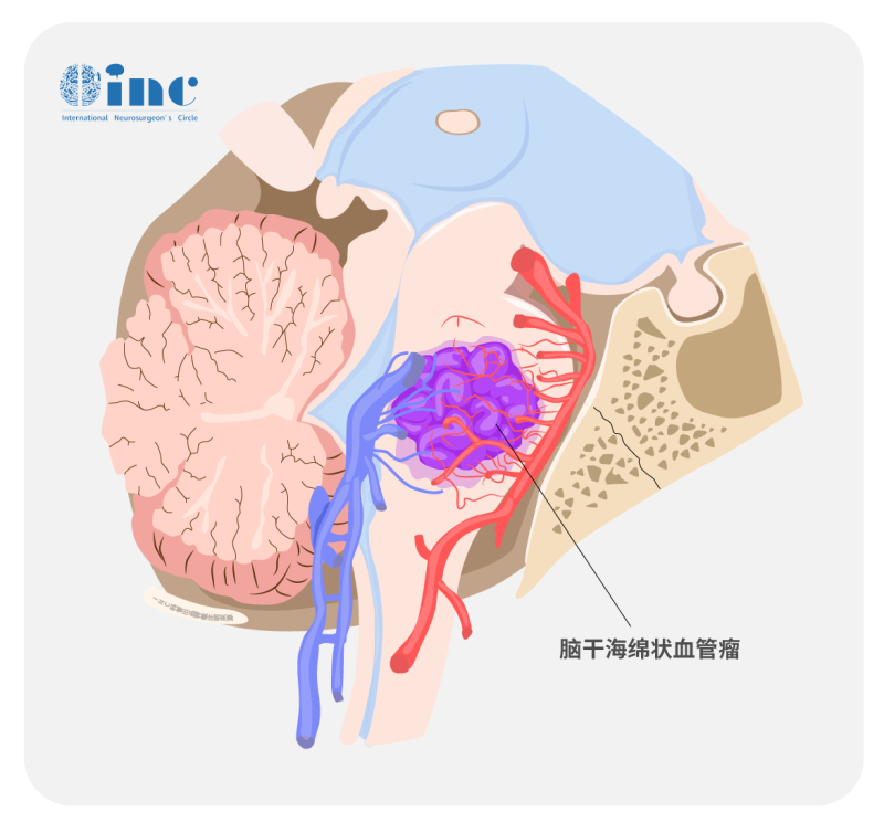 延髓海绵状血管瘤严重吗？延髓海绵状血管瘤的手术治疗策略